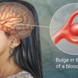 Brain Aneurysm on the rise in Ghana – Radiologist reveals
