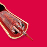 We use embolisation to treat certain cancers and non-cancerous growths
